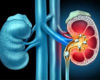 سنگ کلیه, علائم سنگ کلیه, انواع سنگ کلیه,