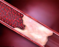 کلسیفیکاسیون, کلسیفیکاسیون تیروئید ، کلیه ، پروستات و رحم, انواع کلسیفیه,